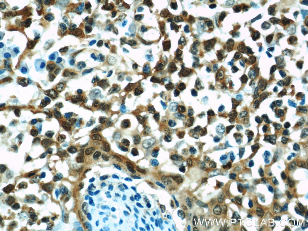 Immunohistochemistry (IHC) staining of human tonsillitis tissue using Cyclophilin A Polyclonal antibody (10720-1-AP)