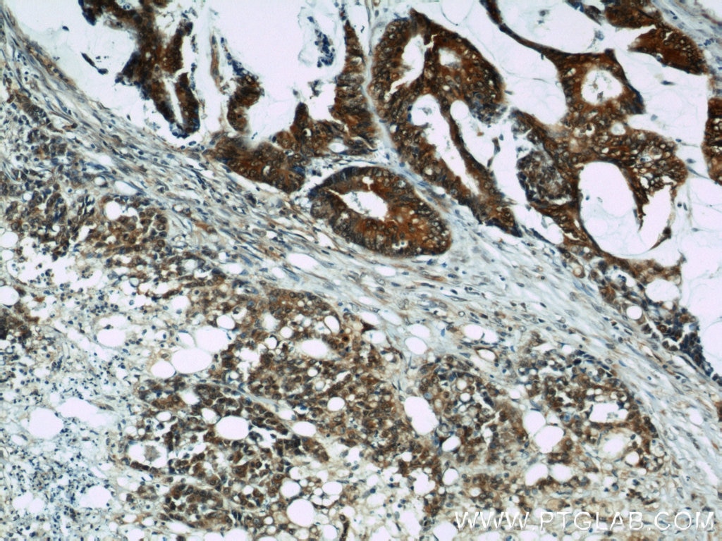Immunohistochemistry (IHC) staining of human colon cancer tissue using Cyclophilin A Polyclonal antibody (10720-1-AP)