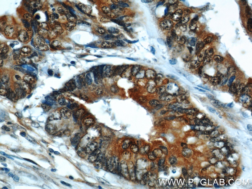 Immunohistochemistry (IHC) staining of human colon cancer tissue using Cyclophilin A Polyclonal antibody (10720-1-AP)