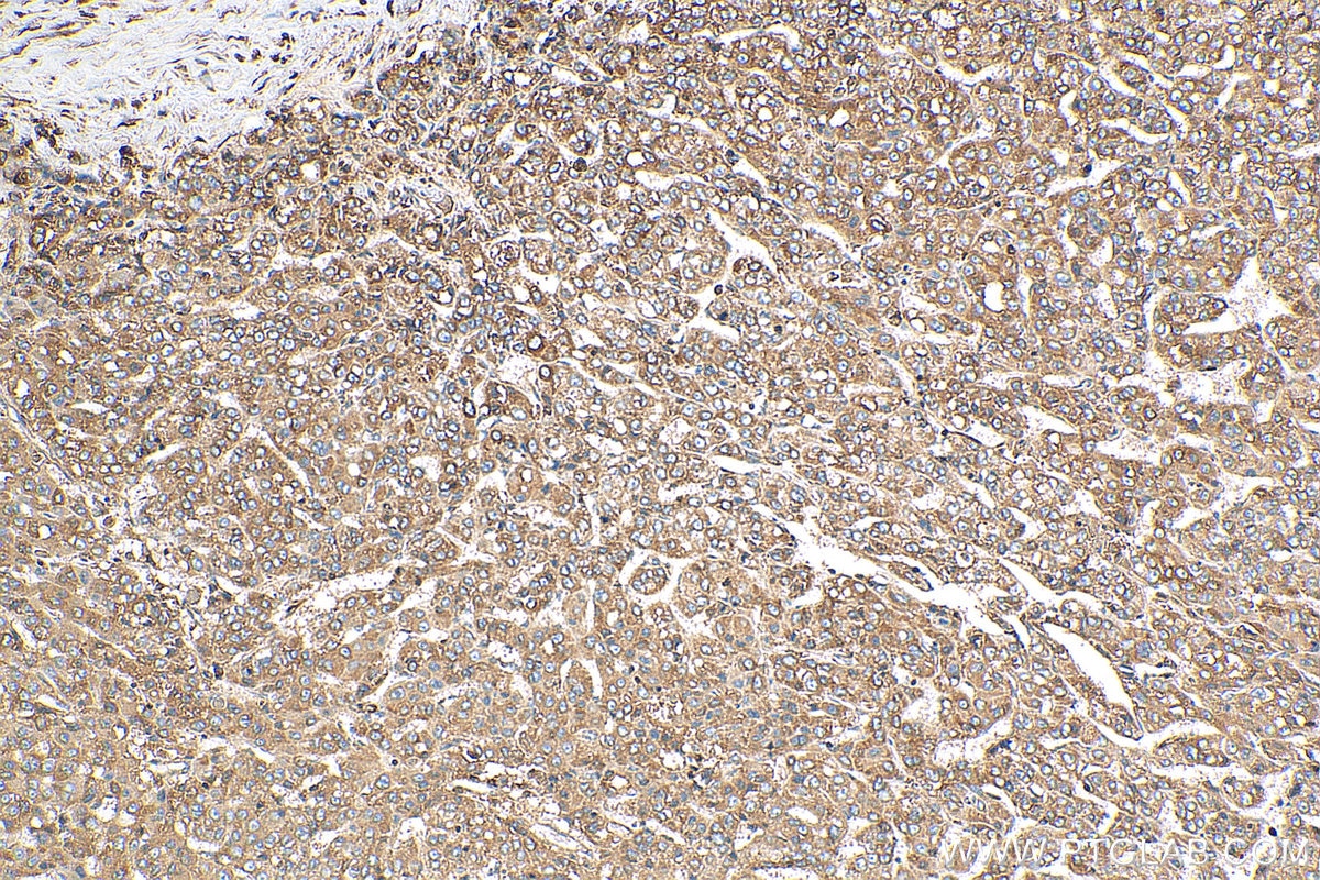 Immunohistochemistry (IHC) staining of human liver cancer tissue using Cyclophilin B Polyclonal antibody (11607-1-AP)