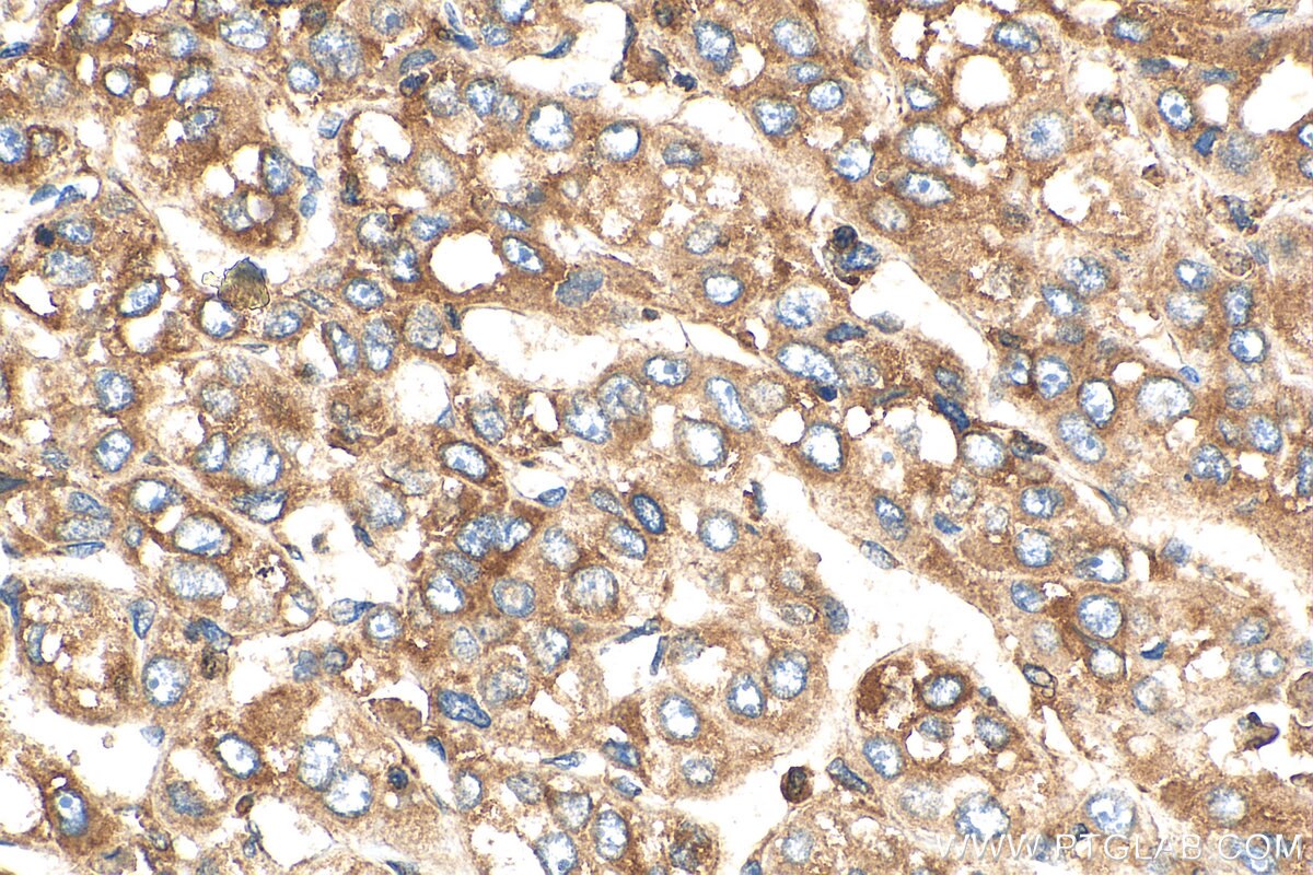 Immunohistochemistry (IHC) staining of human liver cancer tissue using Cyclophilin B Polyclonal antibody (11607-1-AP)