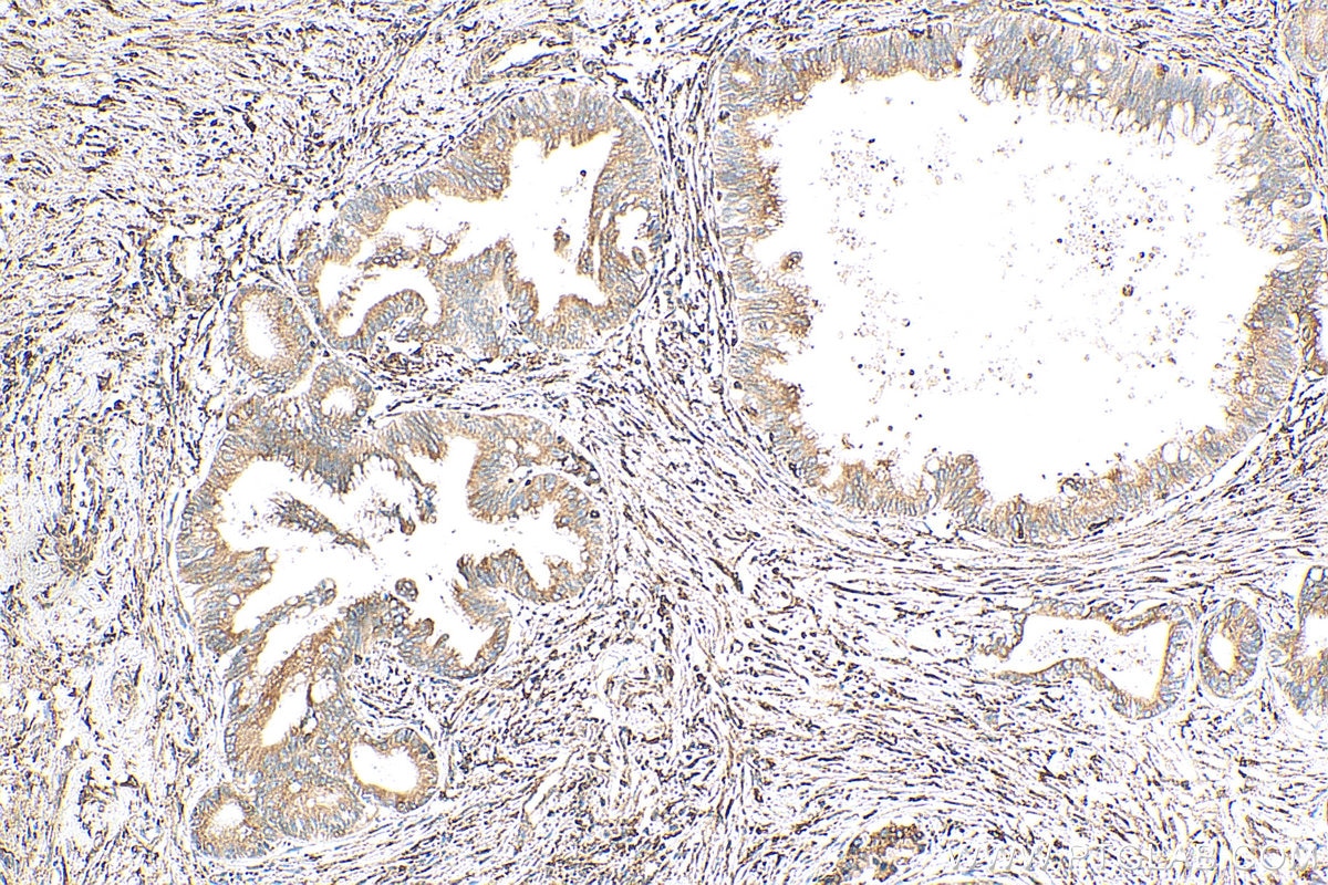 Immunohistochemistry (IHC) staining of human pancreas cancer tissue using Cyclophilin B Polyclonal antibody (11607-1-AP)