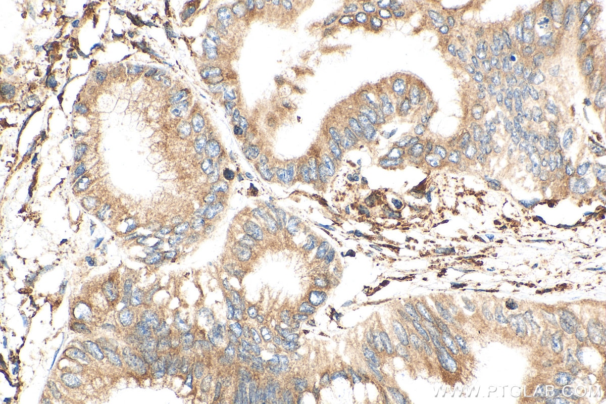 Immunohistochemistry (IHC) staining of human pancreas cancer tissue using Cyclophilin B Polyclonal antibody (11607-1-AP)