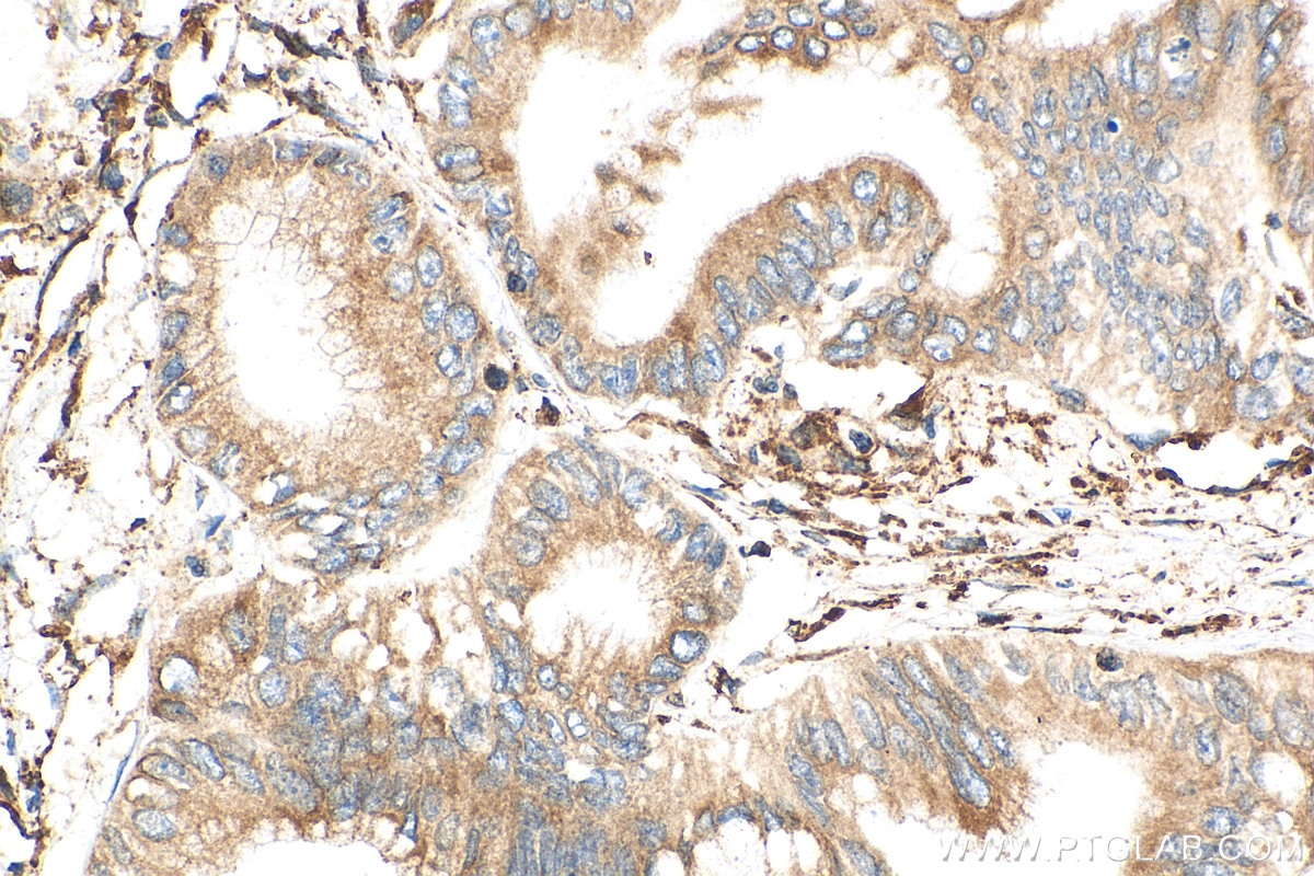 Immunohistochemistry (IHC) staining of human pancreas cancer tissue using Cyclophilin B Polyclonal antibody (11607-1-AP)