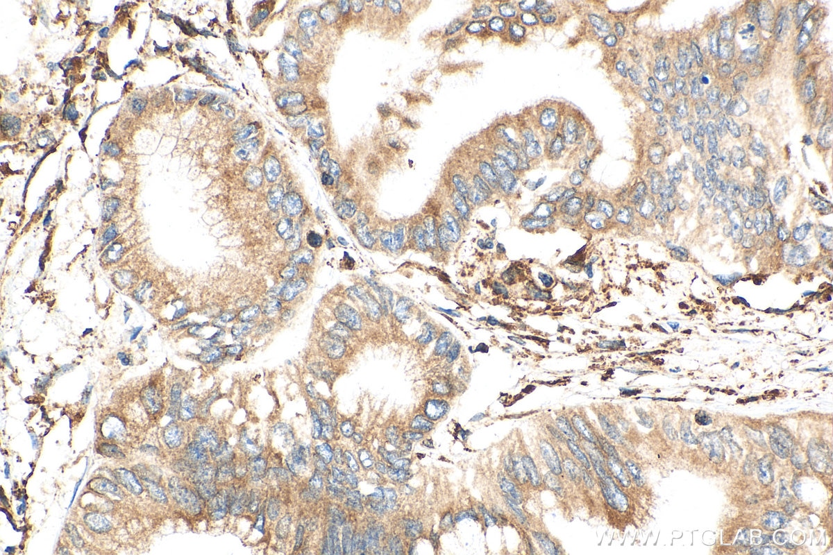 IHC staining of human pancreas cancer using 11607-1-AP