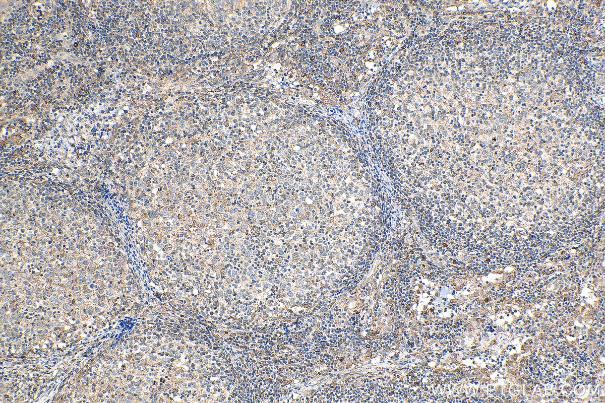 Immunohistochemistry (IHC) staining of human lymphoma tissue using Cyclophilin B Polyclonal antibody (11607-1-AP)