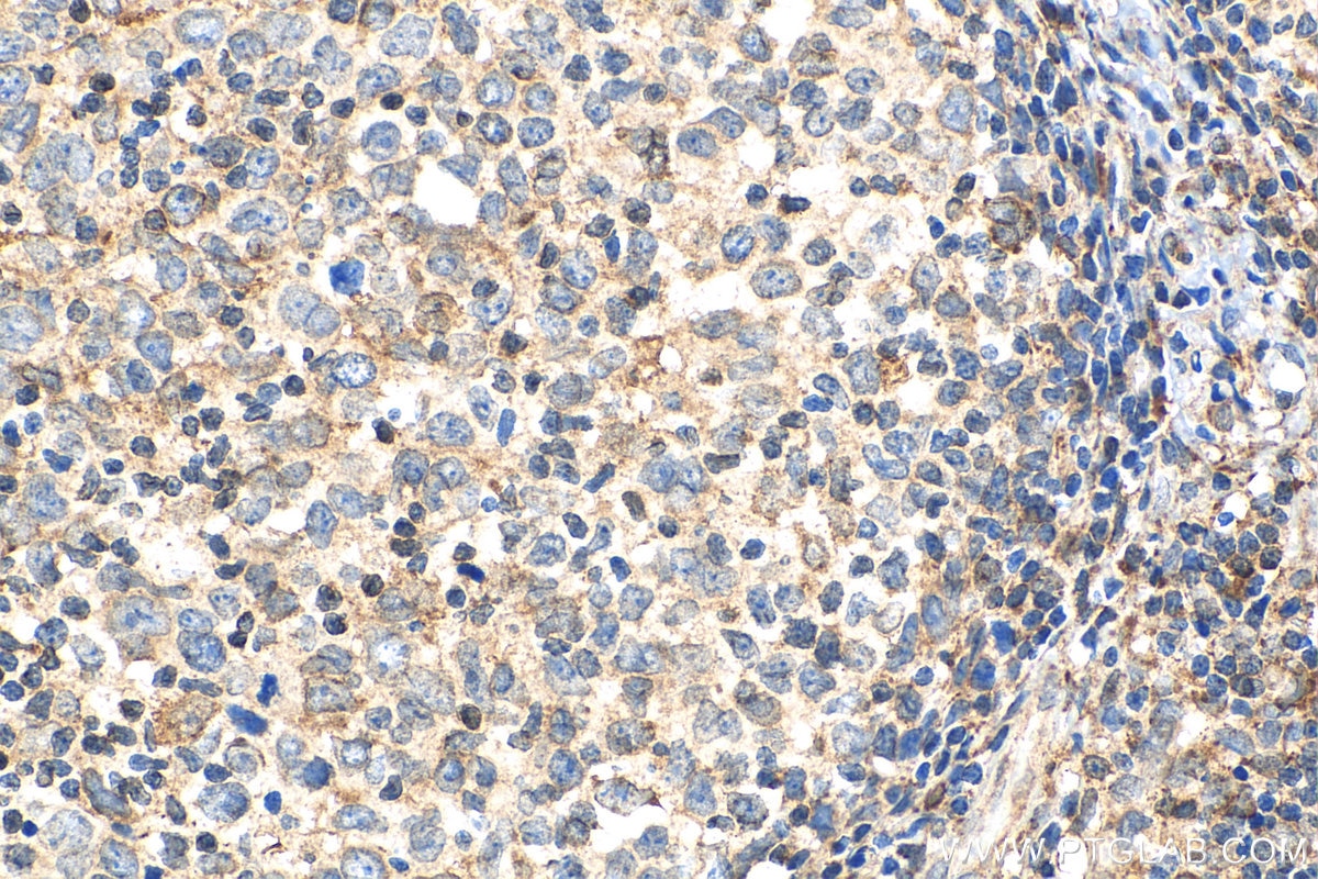 Immunohistochemistry (IHC) staining of human lymphoma tissue using Cyclophilin B Polyclonal antibody (11607-1-AP)