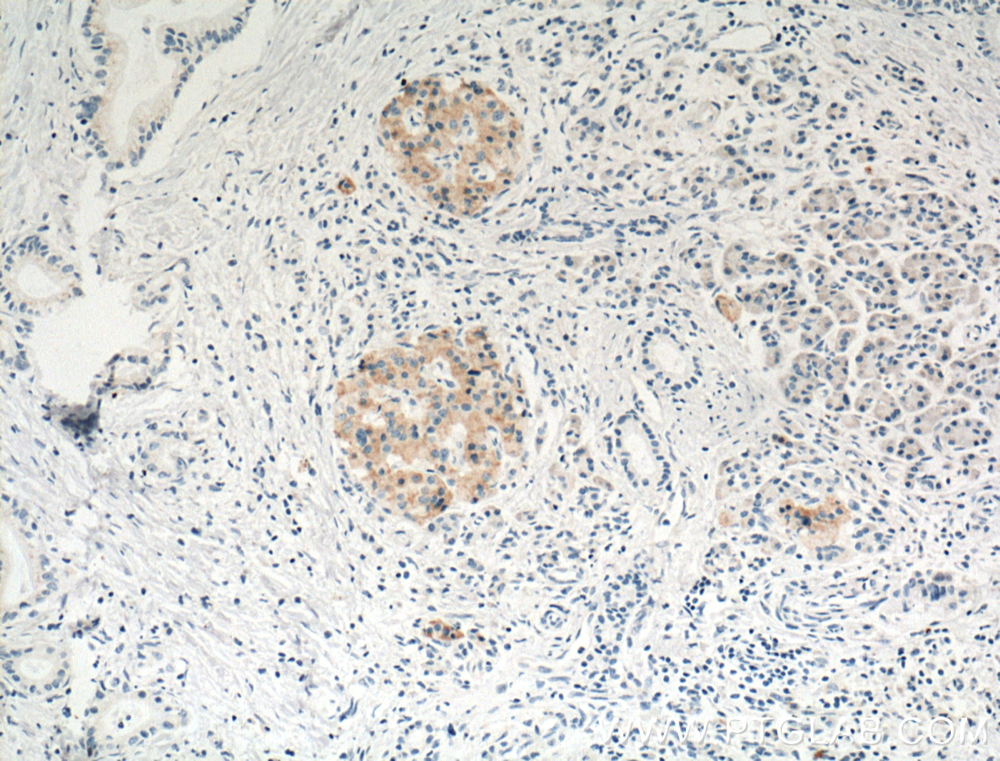 Immunohistochemistry (IHC) staining of human pancreas cancer tissue using Cyclophilin B Monoclonal antibody (66047-1-Ig)