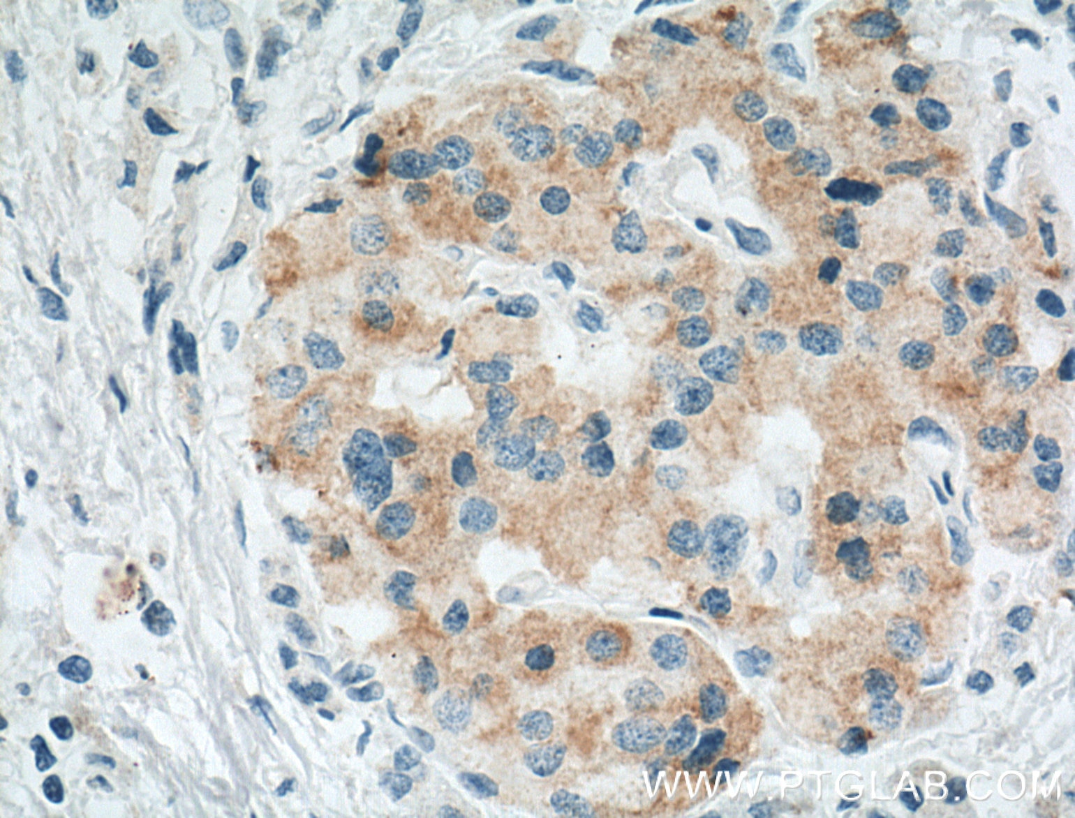 Immunohistochemistry (IHC) staining of human pancreas cancer tissue using Cyclophilin B Monoclonal antibody (66047-1-Ig)