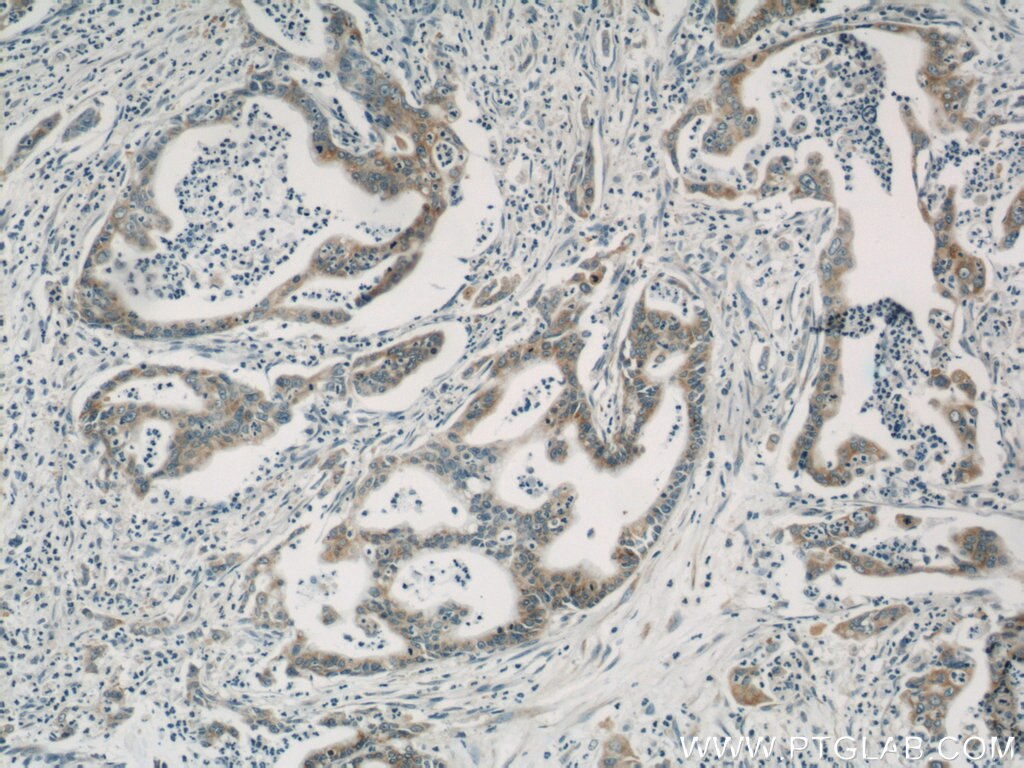 Immunohistochemistry (IHC) staining of human pancreas cancer tissue using Cyclophilin B Monoclonal antibody (66047-1-Ig)