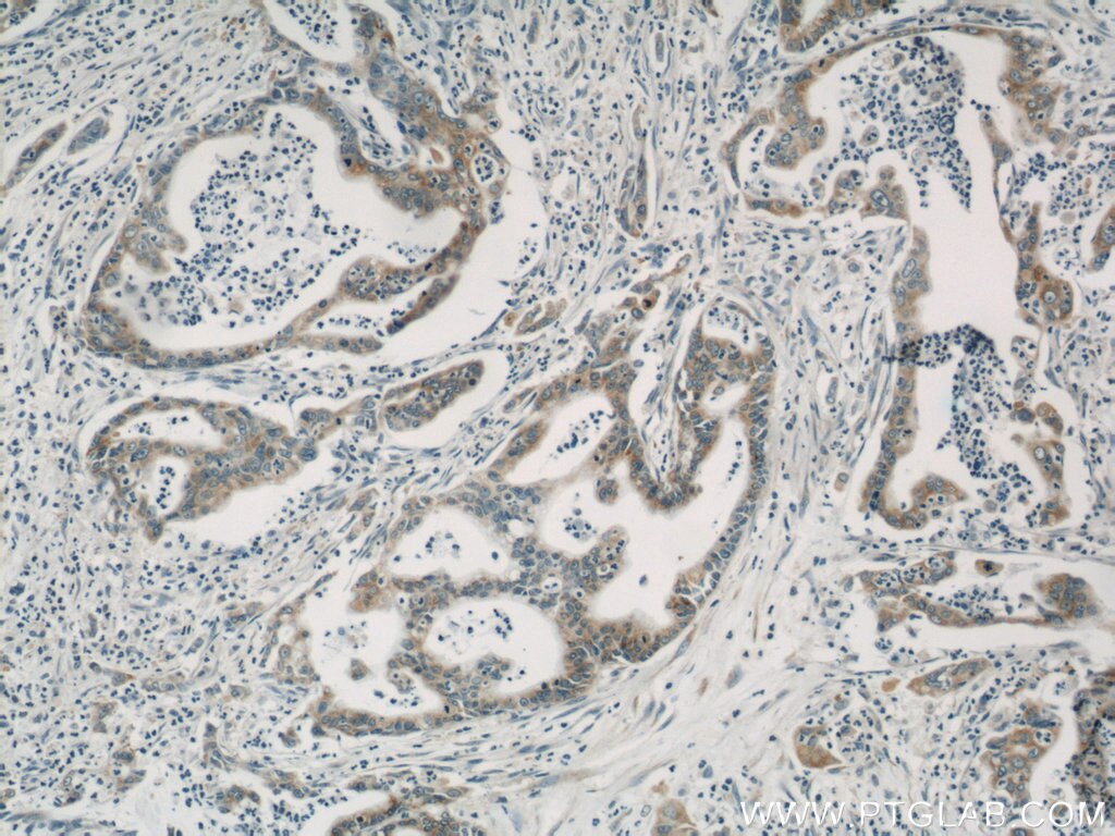 IHC staining of human pancreas cancer using 66047-1-Ig