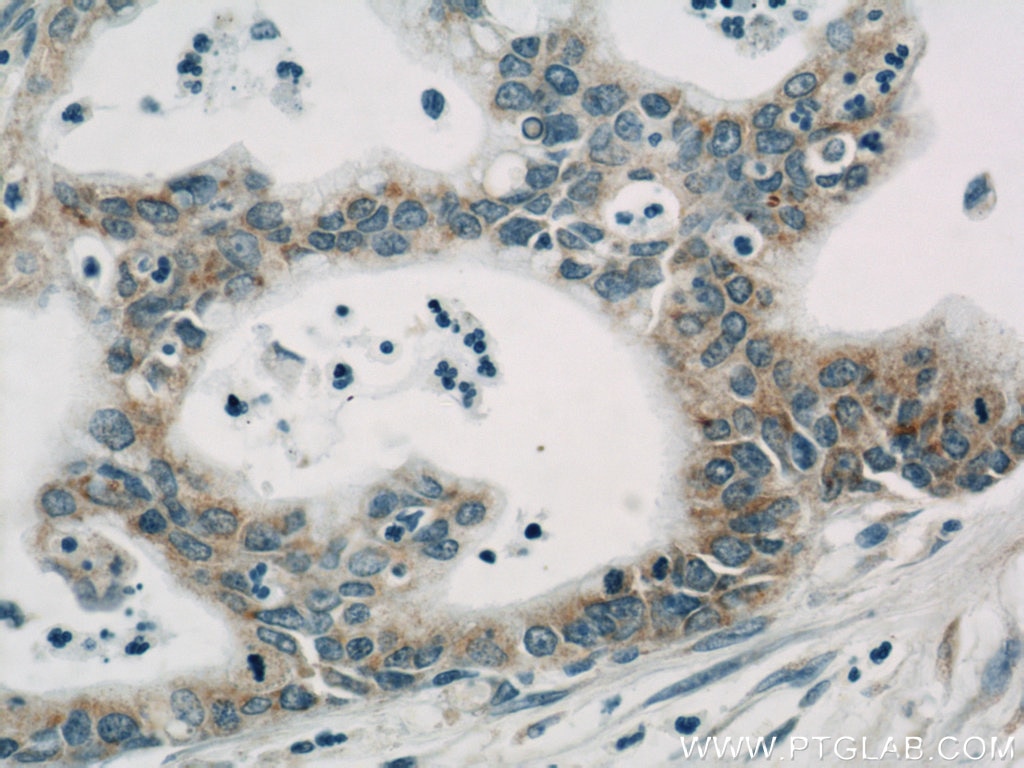 Immunohistochemistry (IHC) staining of human pancreas cancer tissue using Cyclophilin B Monoclonal antibody (66047-1-Ig)