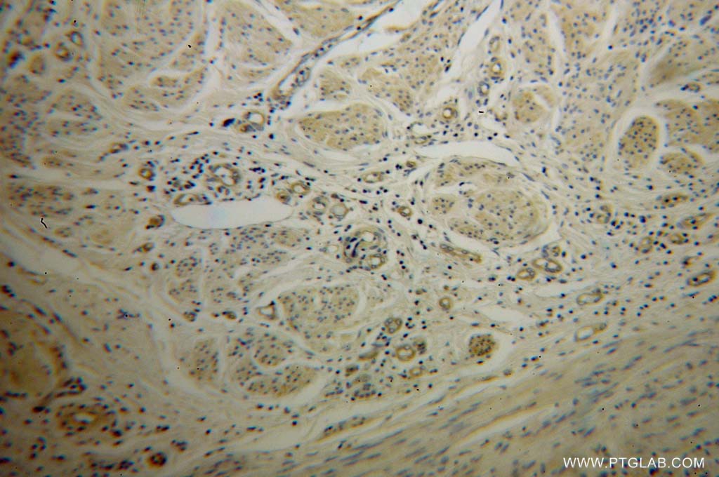 Immunohistochemistry (IHC) staining of human cervical cancer tissue using PPID Polyclonal antibody (12716-1-AP)