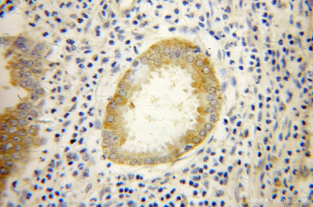Immunohistochemistry (IHC) staining of human cervical cancer tissue using PPID Polyclonal antibody (12716-1-AP)
