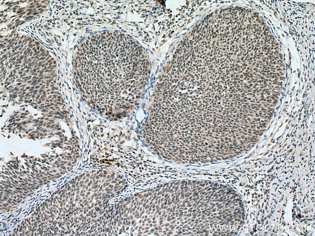 Immunohistochemistry (IHC) staining of human cervical cancer tissue using PPID Monoclonal antibody (67632-1-Ig)