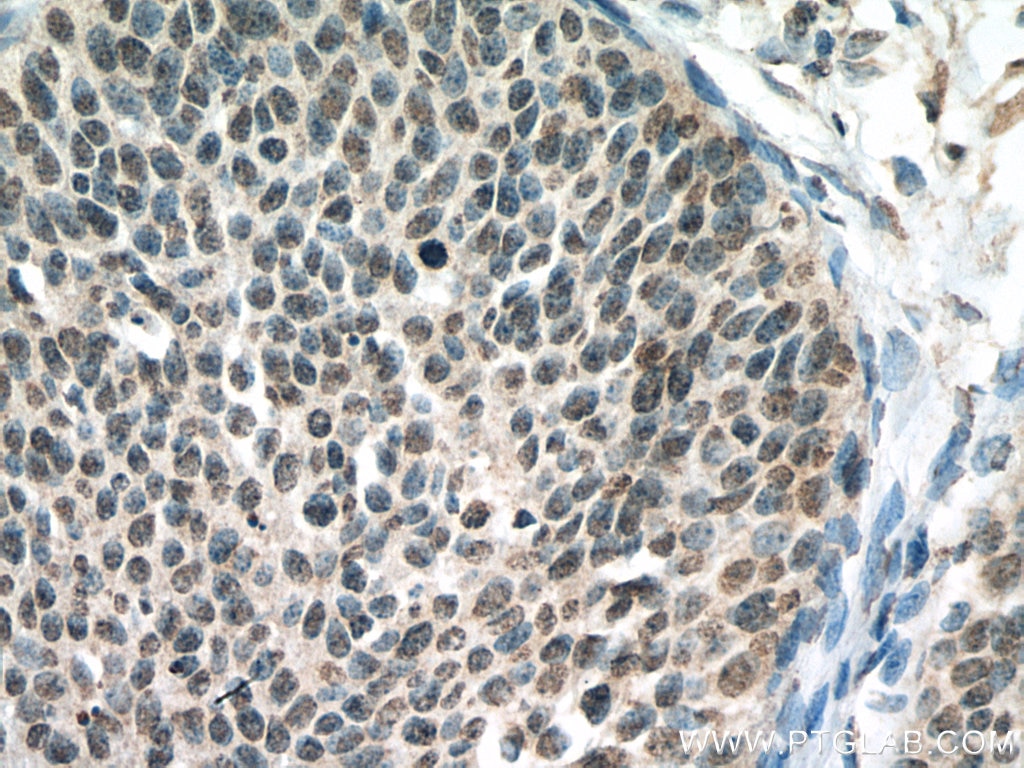 Immunohistochemistry (IHC) staining of human cervical cancer tissue using PPID Monoclonal antibody (67632-1-Ig)