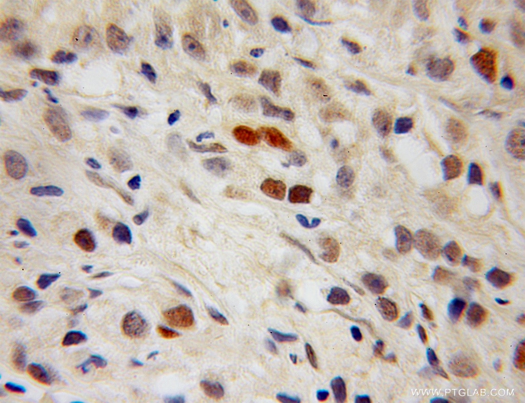 Immunohistochemistry (IHC) staining of human prostate cancer tissue using PPIG Polyclonal antibody (12985-1-AP)