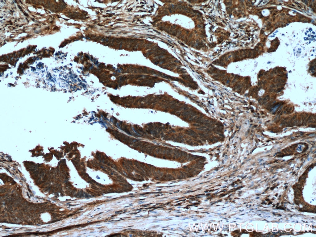 Immunohistochemistry (IHC) staining of human colon cancer tissue using PPIH Polyclonal antibody (11651-1-AP)