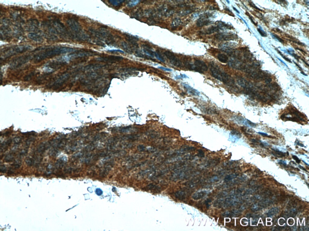 Immunohistochemistry (IHC) staining of human colon cancer tissue using PPIH Polyclonal antibody (11651-1-AP)