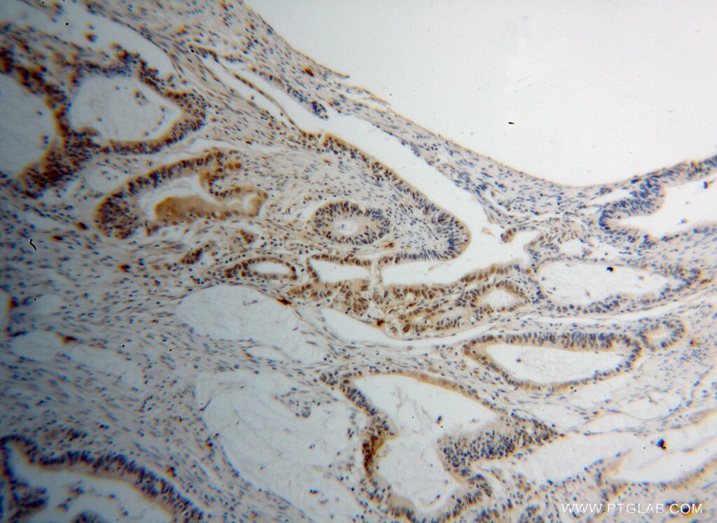 Immunohistochemistry (IHC) staining of human colon cancer tissue using PPIL1 Polyclonal antibody (15144-1-AP)