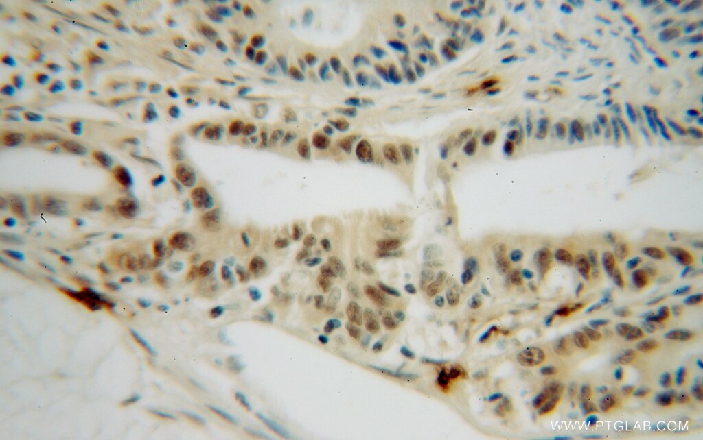Immunohistochemistry (IHC) staining of human colon cancer tissue using PPIL1 Polyclonal antibody (15144-1-AP)
