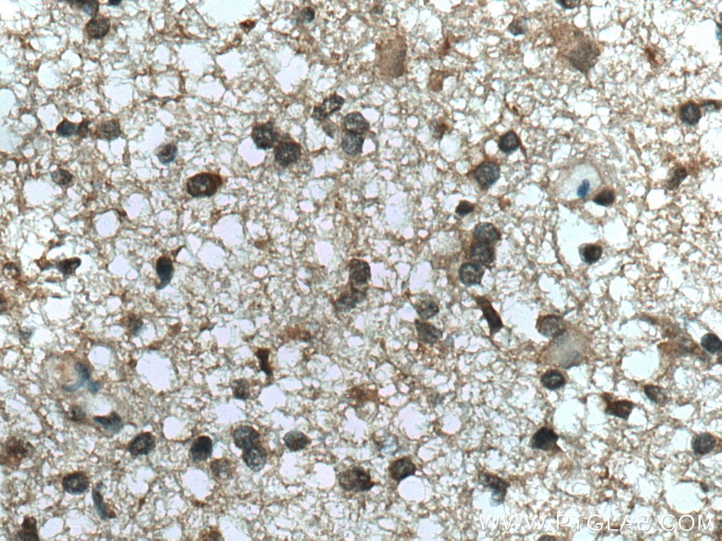 Immunohistochemistry (IHC) staining of human gliomas tissue using PPIL3 Polyclonal antibody (15671-1-AP)