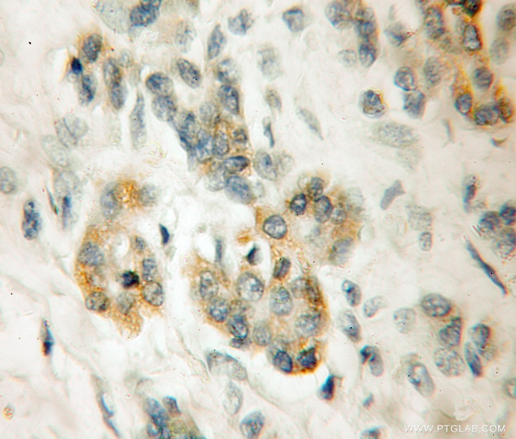 Immunohistochemistry (IHC) staining of human pancreas cancer tissue using LRR 1 Polyclonal antibody (11628-1-AP)