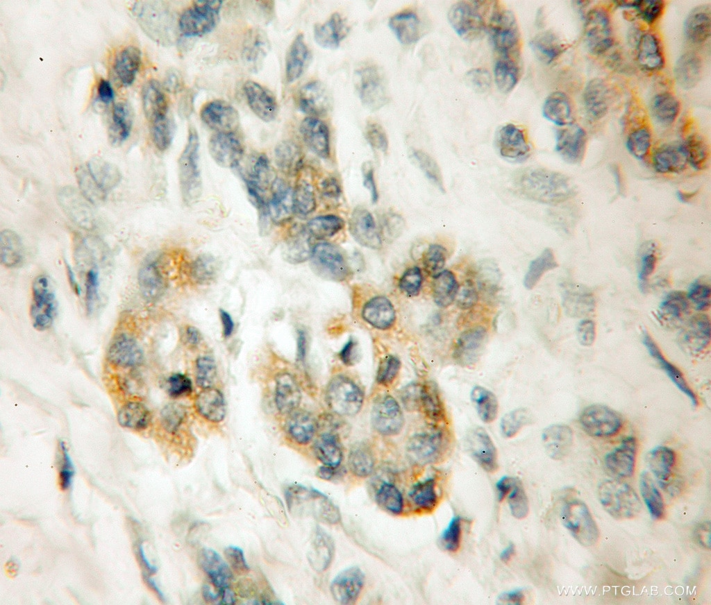 IHC staining of human pancreas cancer using 11628-1-AP