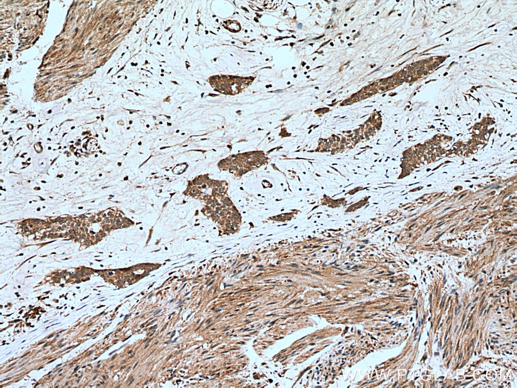 Immunohistochemistry (IHC) staining of human urothelial carcinoma tissue using PPM1A Polyclonal antibody (12961-1-AP)