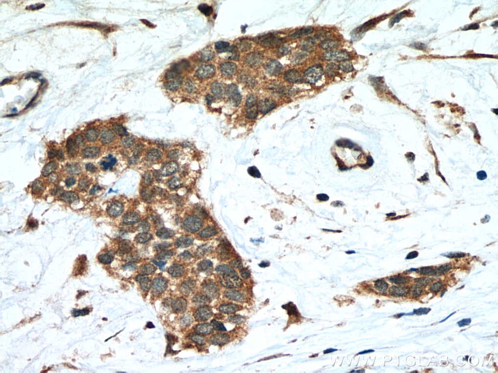 IHC staining of human urothelial carcinoma using 12961-1-AP