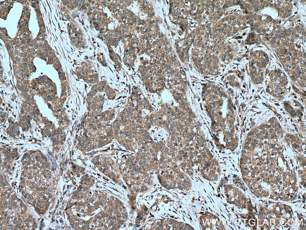 Immunohistochemistry (IHC) staining of human breast cancer tissue using PPM1A Polyclonal antibody (12961-1-AP)