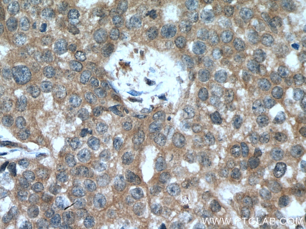 Immunohistochemistry (IHC) staining of human breast cancer tissue using PPM1A Polyclonal antibody (12961-1-AP)