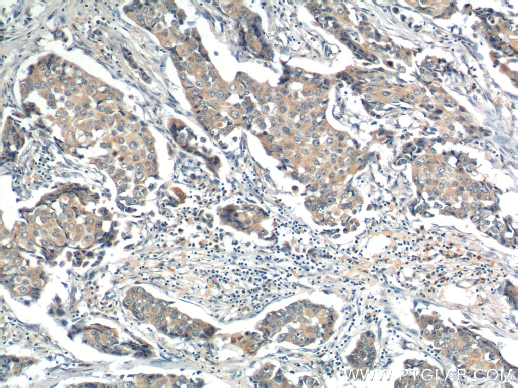 IHC staining of human breast cancer using 13193-1-AP