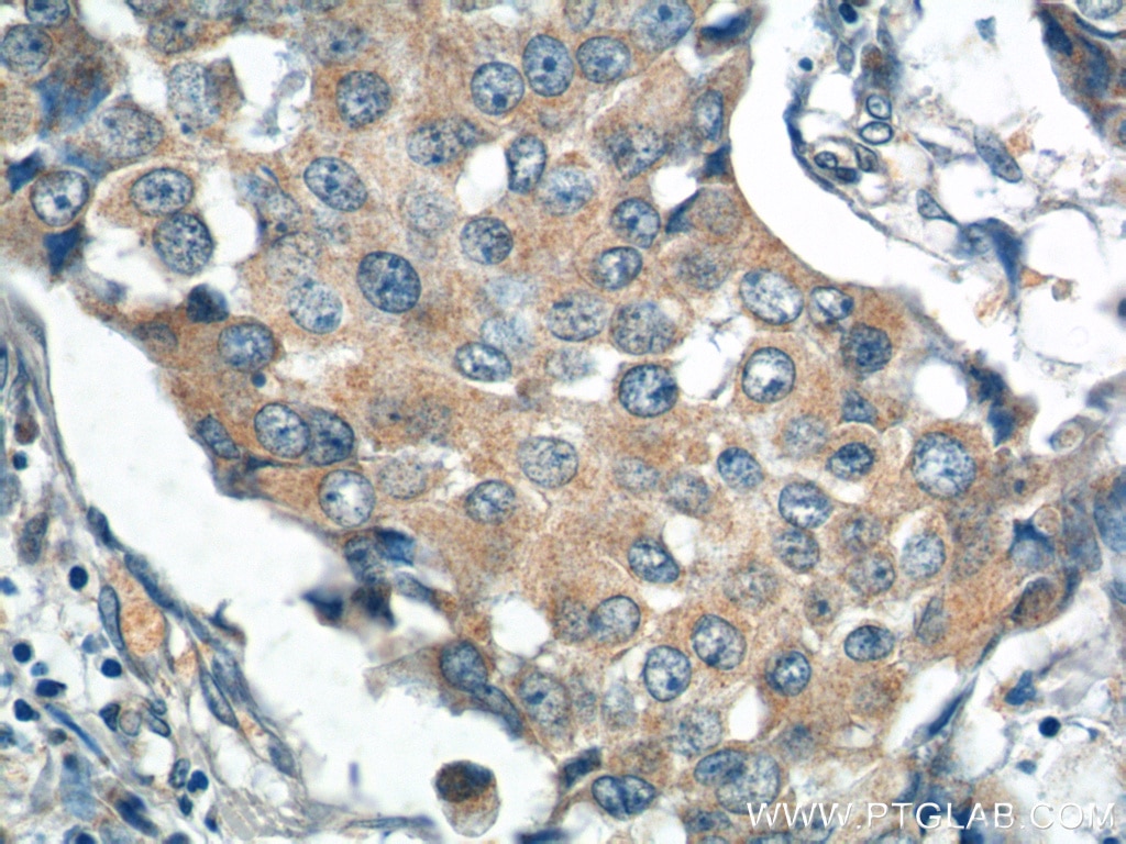 Immunohistochemistry (IHC) staining of human breast cancer tissue using PPM1B Polyclonal antibody (13193-1-AP)