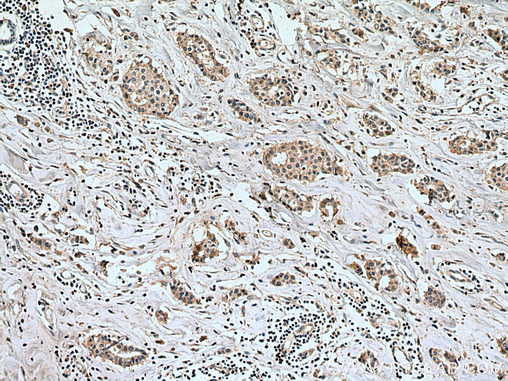 IHC staining of human breast cancer using 67647-1-Ig