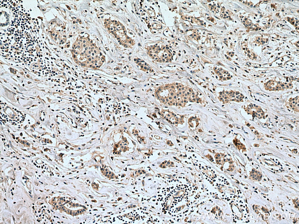 Immunohistochemistry (IHC) staining of human breast cancer tissue using PPM1B Monoclonal antibody (67647-1-Ig)