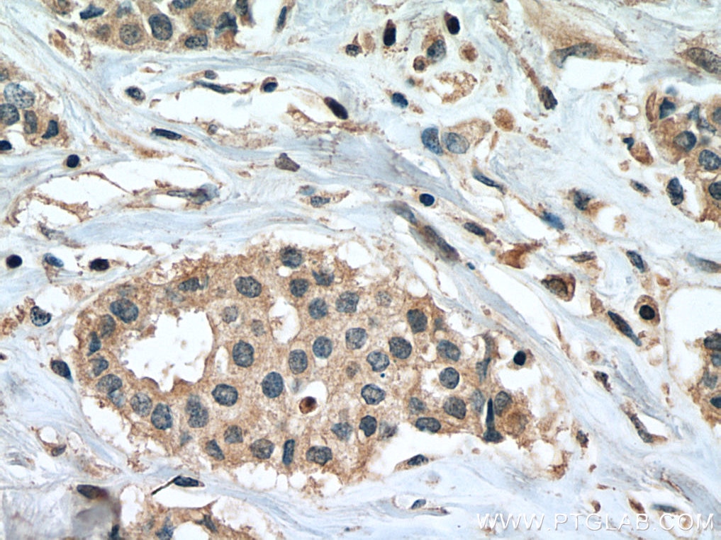 Immunohistochemistry (IHC) staining of human breast cancer tissue using PPM1B Monoclonal antibody (67647-1-Ig)