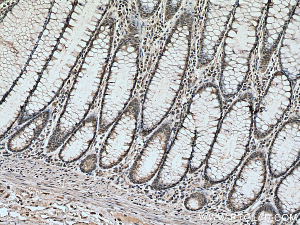 Immunohistochemistry (IHC) staining of human colon cancer tissue using PPM1D Monoclonal antibody (67440-1-Ig)