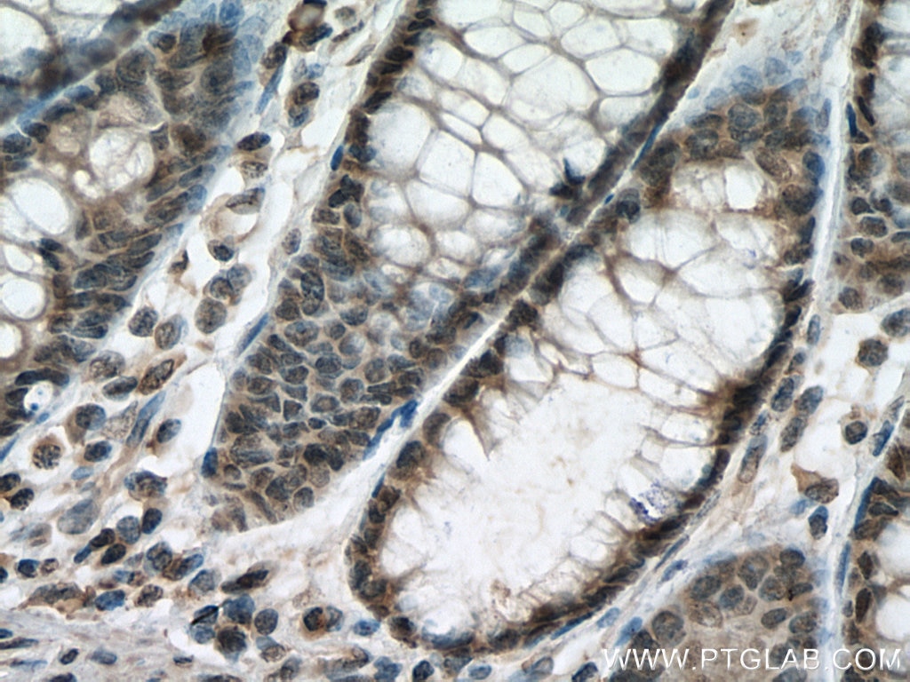 Immunohistochemistry (IHC) staining of human colon cancer tissue using PPM1D Monoclonal antibody (67440-1-Ig)