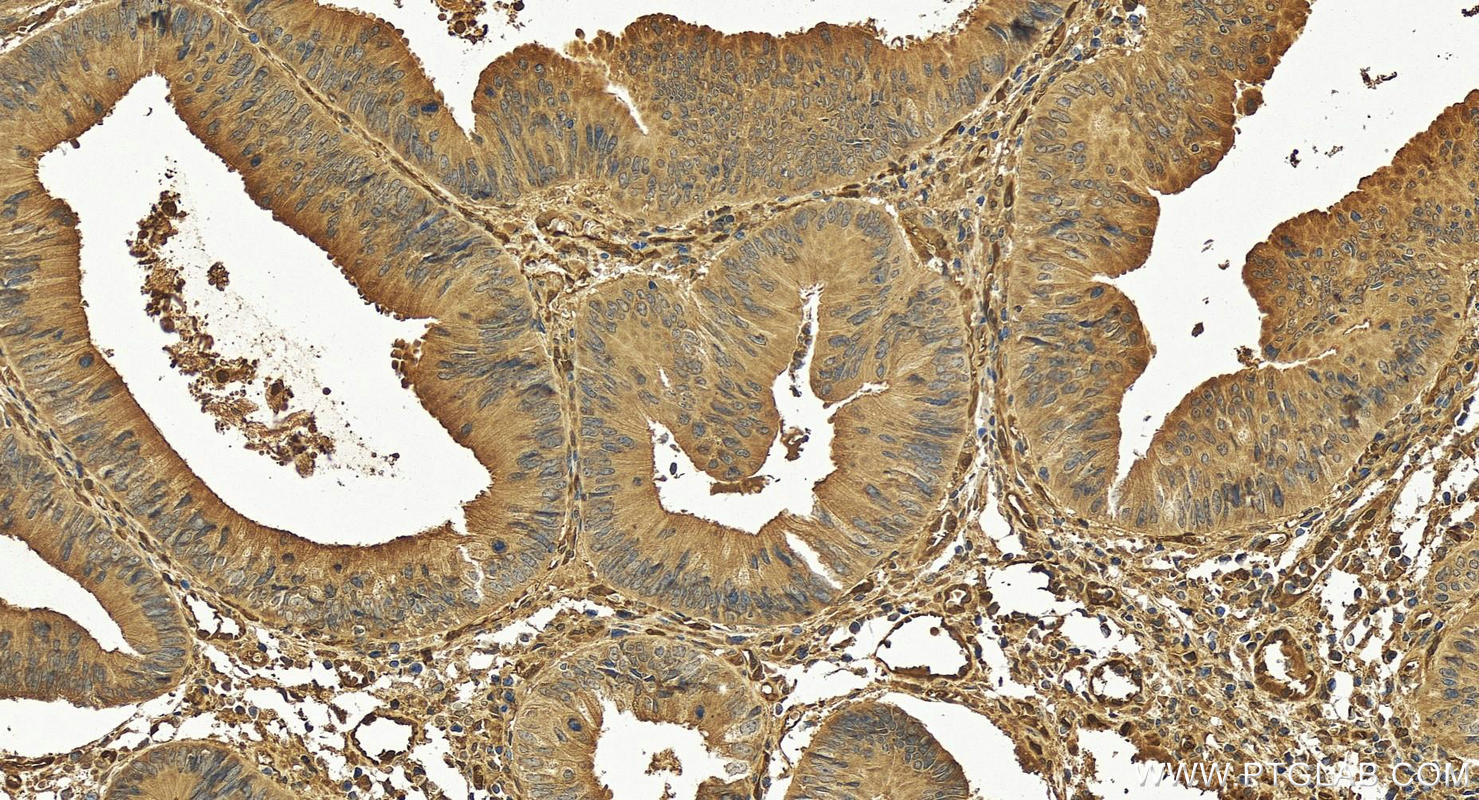 Immunohistochemistry (IHC) staining of human colon cancer tissue using PPM1F Polyclonal antibody (17020-1-AP)