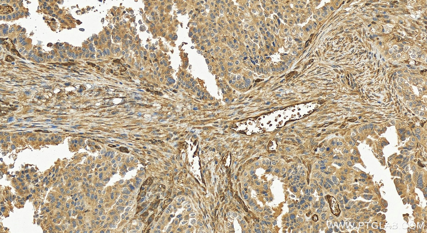 Immunohistochemistry (IHC) staining of human ovary cancer tissue using PPM1F Polyclonal antibody (17020-1-AP)