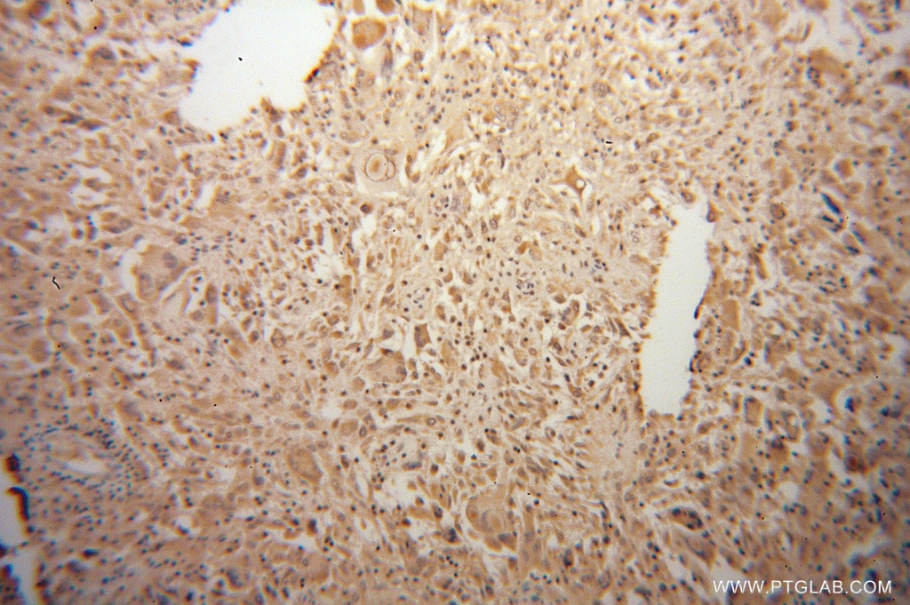 Immunohistochemistry (IHC) staining of human gliomas tissue using PPM1K Polyclonal antibody (14573-1-AP)