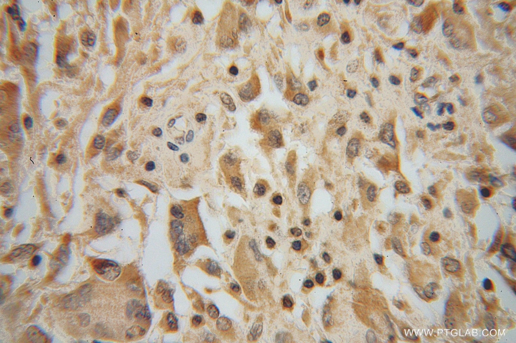 Immunohistochemistry (IHC) staining of human gliomas tissue using PPM1K Polyclonal antibody (14573-1-AP)