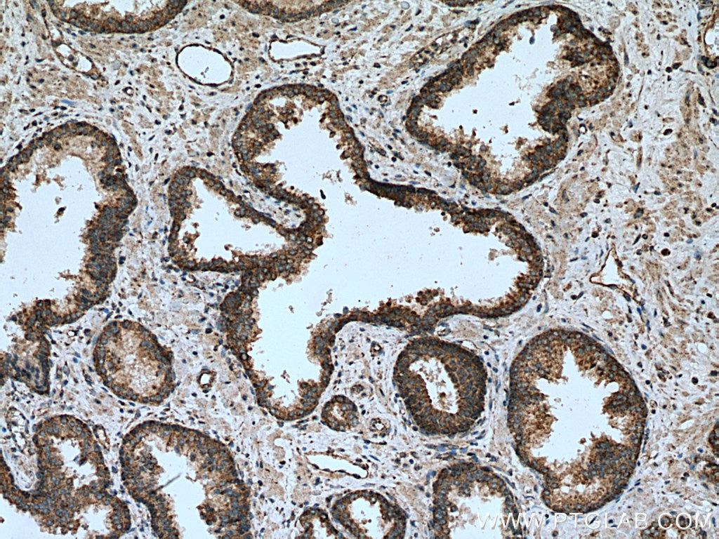 Immunohistochemistry (IHC) staining of human prostate cancer tissue using PDP1 Polyclonal antibody (21176-1-AP)