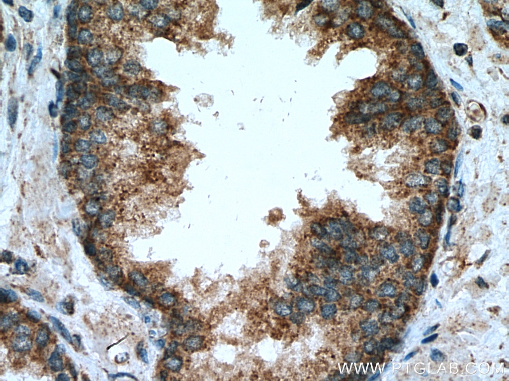 Immunohistochemistry (IHC) staining of human prostate cancer tissue using PDP1 Polyclonal antibody (21176-1-AP)