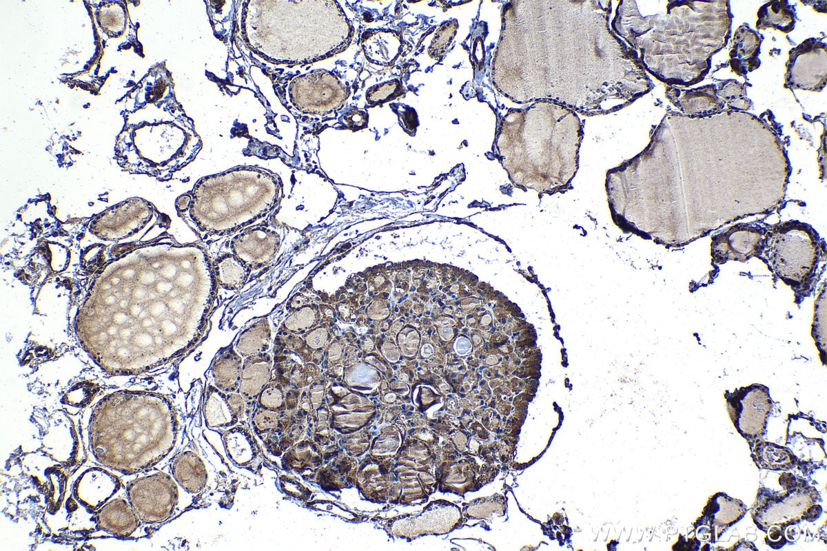 Immunohistochemistry (IHC) staining of human thyroid cancer tissue using PDP1 Polyclonal antibody (21176-1-AP)