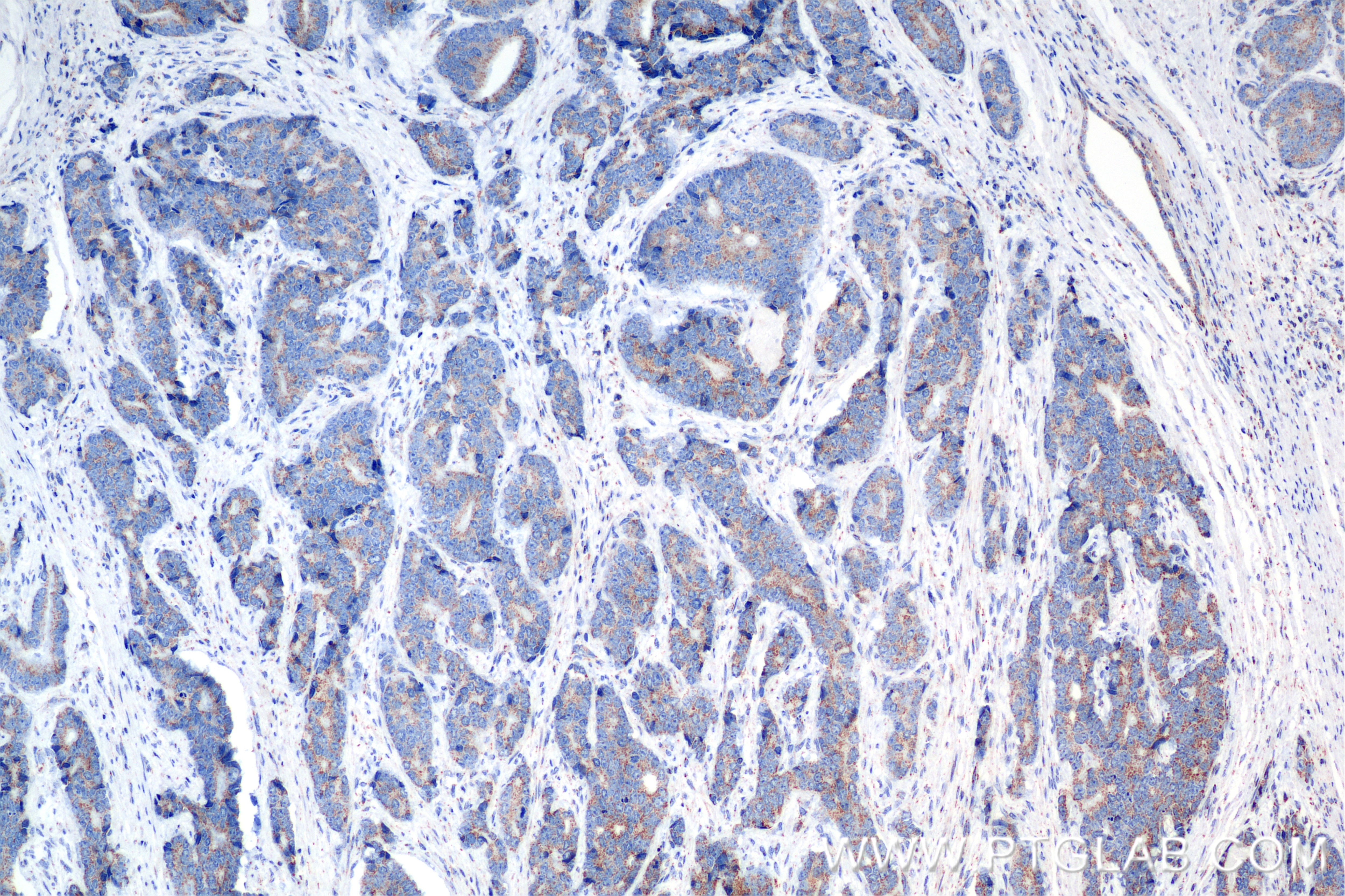 Immunohistochemistry (IHC) staining of human prostate cancer tissue using PDP1 Recombinant antibody (84612-3-RR)