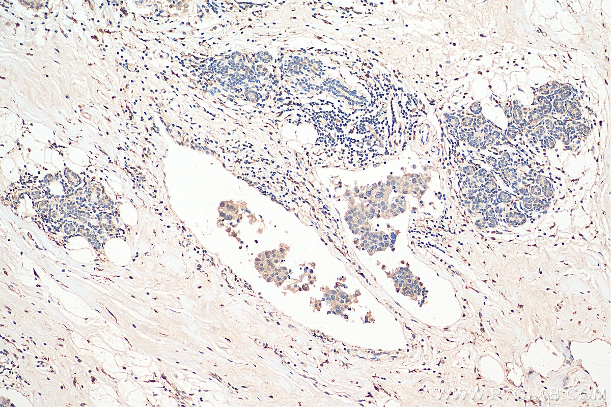 Immunohistochemistry (IHC) staining of human breast cancer tissue using PPP1CA Polyclonal antibody (28617-1-AP)