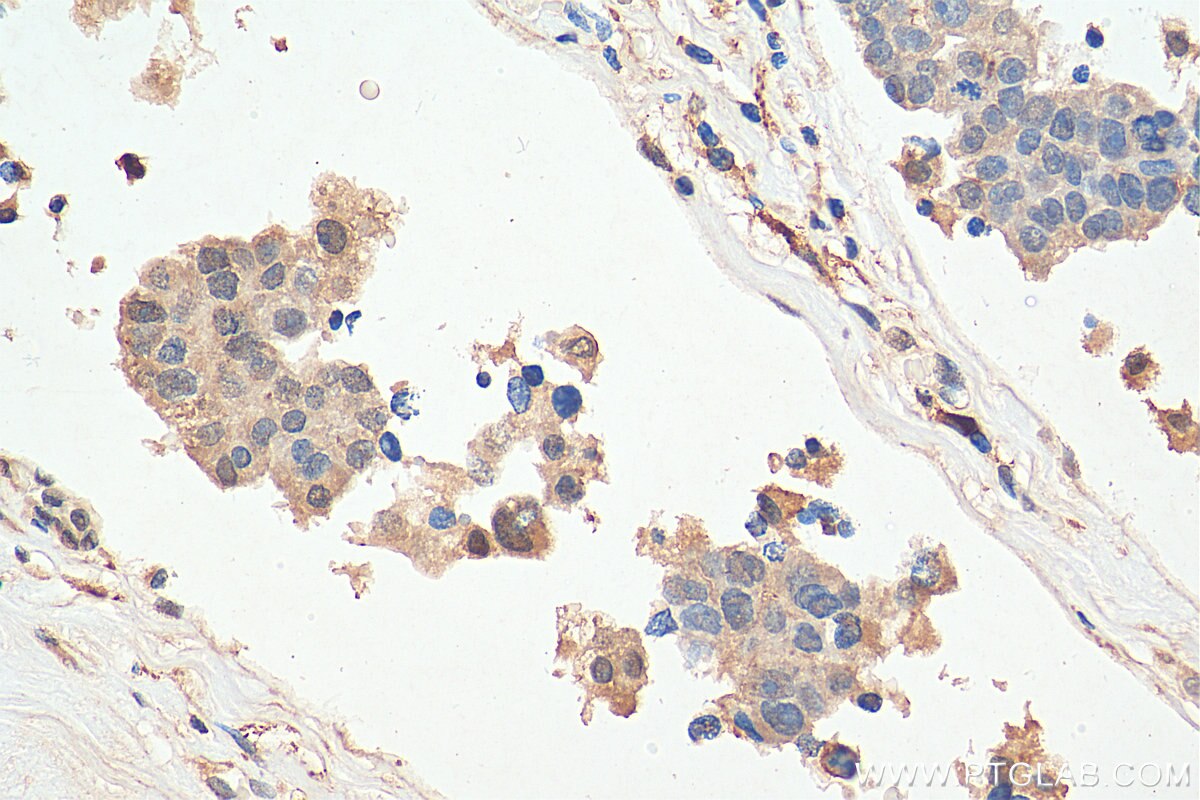 Immunohistochemistry (IHC) staining of human breast cancer tissue using PPP1CA Polyclonal antibody (28617-1-AP)
