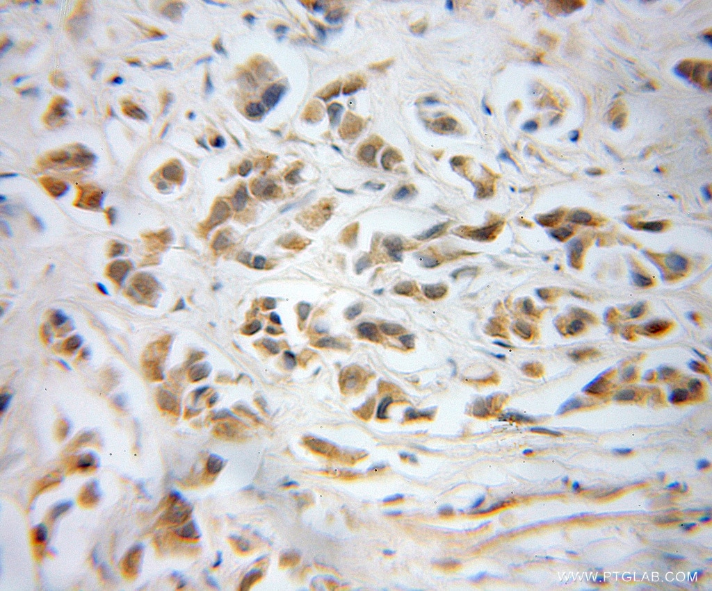 Immunohistochemistry (IHC) staining of human prostate cancer tissue using PPP1CB-Specific Polyclonal antibody (10140-2-AP)